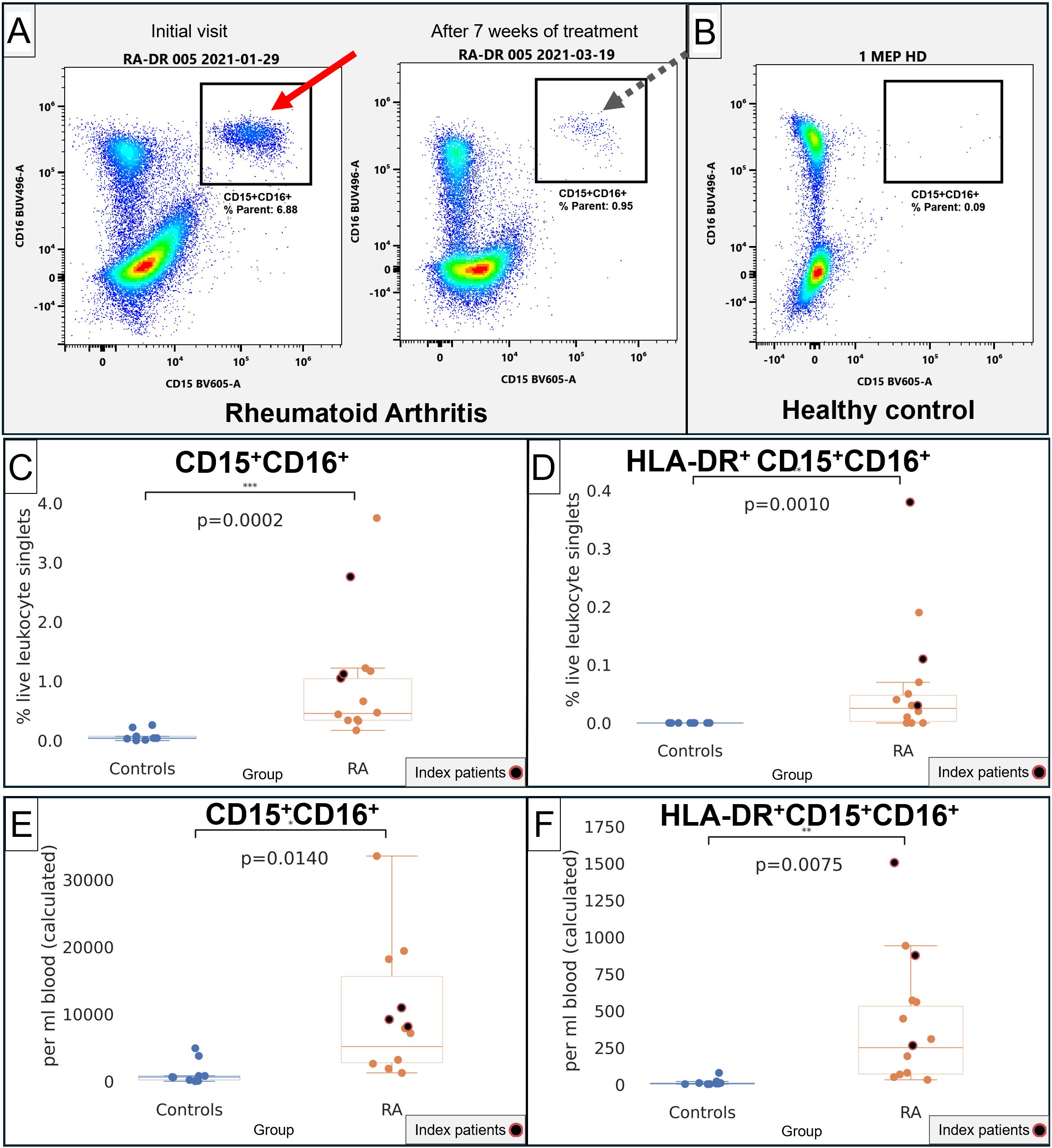 Flow cytometry and scatter plots analyzing leukocyte populations in patients with rheumatoid arthritis (RA) and healthy controls. Panel A shows flow cytometry plots for a patient with RA at the initial visit and after seven weeks of treatment, highlighting CD15+CD16+ cells. Panel B shows data for a healthy control. Panels C and E compare the percentage and concentration, respectively, of CD15+CD16+ cells between controls and RA patients, with significant differences indicated by p-values. Panels D and F compare the same metrics for HLA-DR+ CD15+CD16+ cells, again showing significant differences.