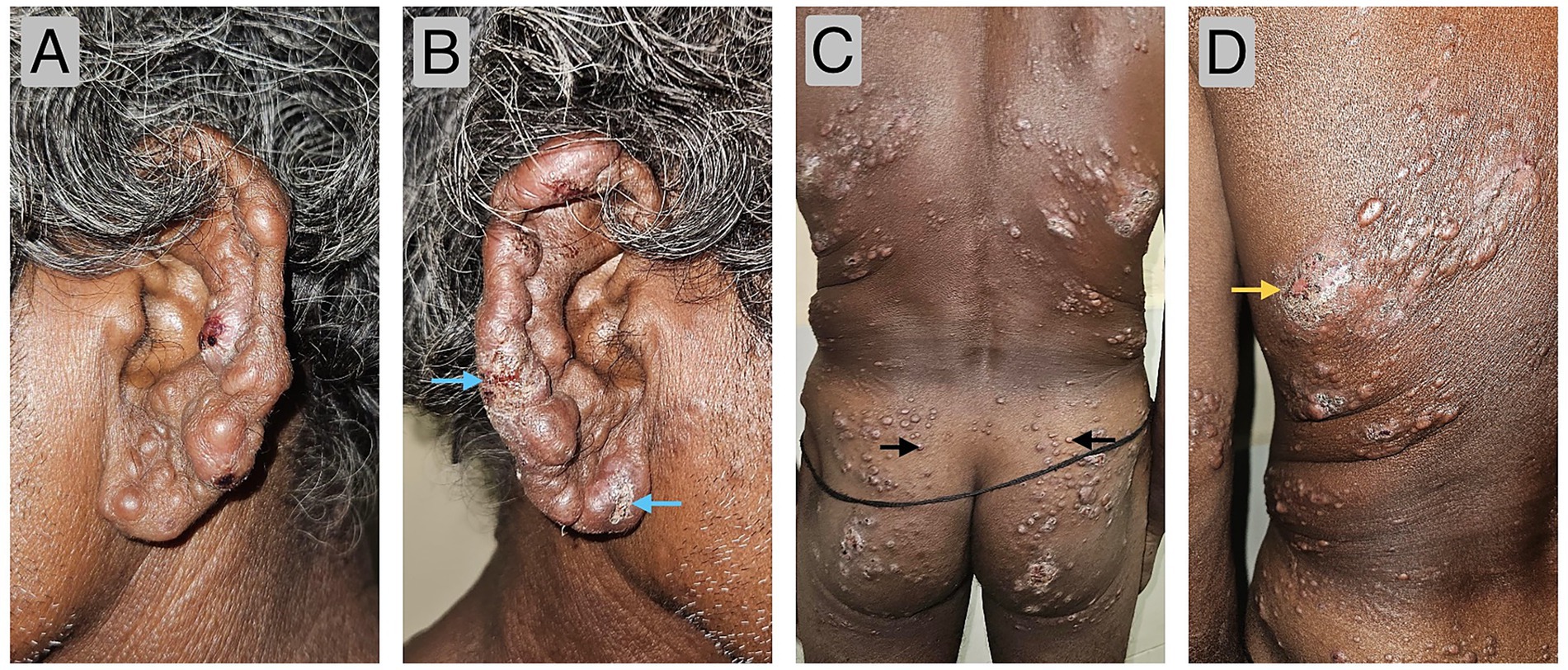 Panel A shows a close-up of an ear with numerous raised nodules. Panel B Clinical images of the bilateral external ear showing papulonodular thickening of the ear helices, anti-helices and pinnae along with “rat-bite” ulcers over the helices and left ear lobe (blue arrows). Panel C depicts a back view, showing widespread nodular growths along the skin. Panel D captures a side view of the torso, with clusters of nodules and a focused lesion marked by an arrow.