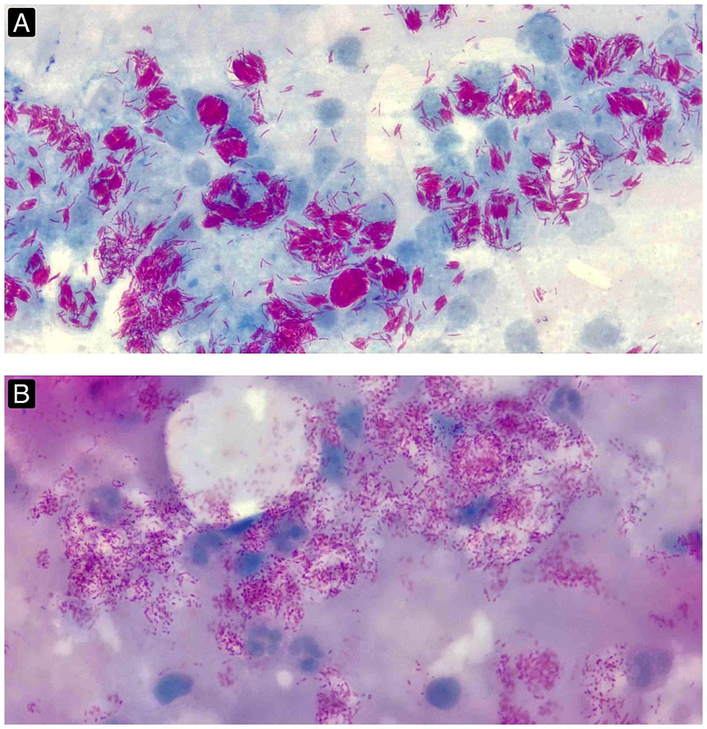 (A) SSS stained using the modified ZN method, demonstrating multiple clusters of acid-fast bacilli and globi set against a pale blue, monocytic background (BI 6 + and MI 95%). (Images obtained with a 10x ocular lens and a 100x oil-immersion objective lens, yielding an e!ective magnification of 1,000x). (B) SSS stained with the modified ZN method 1 month after initiation of RO therapy, revealing multiple fragmented and granular AFB (BI 6 + and MI 0). (Images obtained with a 10x ocular lens and a 100x oil-immersion objective lens, yielding an e!ective magnification of 1,000x).