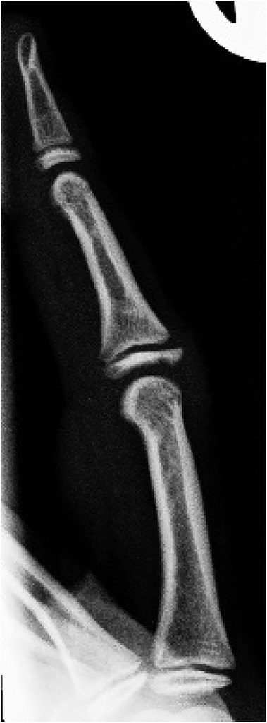 X-ray image of a human finger showing three clearly defined phalanges. The bones are aligned with notable joint spaces between them, and the surrounding tissue appears faintly in the background.