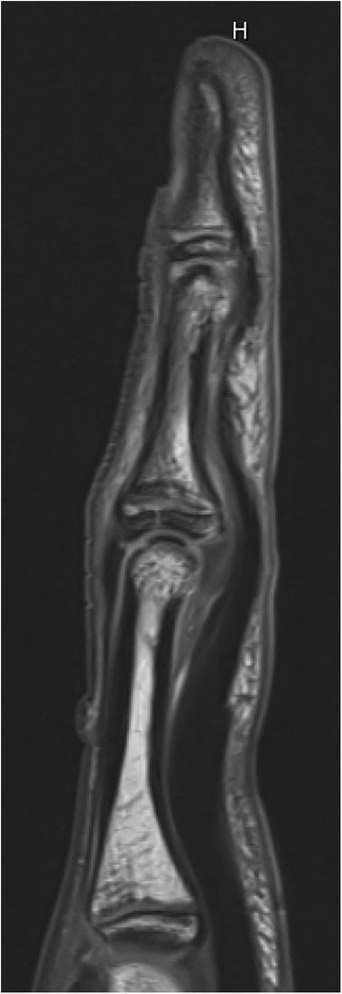 MRI scan of a finger in a sagittal view showing the internal structures, including bones, joints, and soft tissues, in varying shades of gray on a black background. A letter \