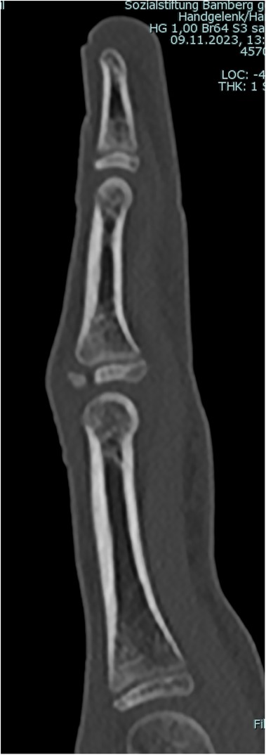 CT scan of a finger showing the bones of the phalanges in detail. The image is labeled with technical specifications including slice thickness and location details.