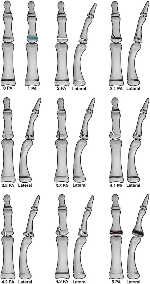 Illustration of finger joint dislocations shown in various stages and views. Rows depict progression from mild to severe dislocations. Each row compares PA (posteroanterior) and lateral X-ray views with increasing deformity, angles, and joint separations.