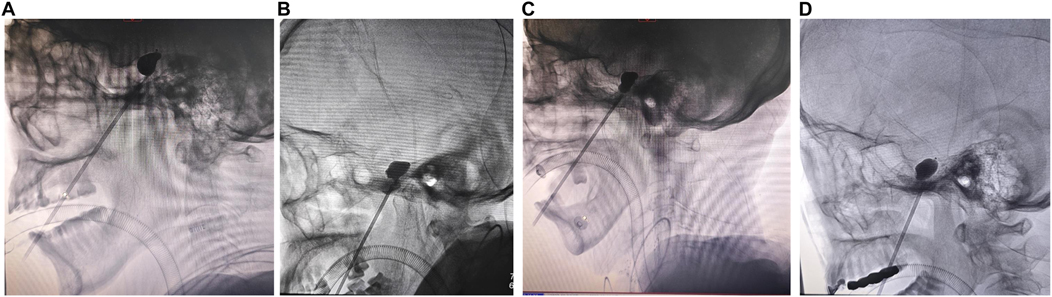 Four panels labeled A to D show lateral X-ray images during a medical procedure. Each image displays a profile view of a skull with various medical instruments inserted, focusing on a particular area likely related to endovascular treatment. The dark contrast spot indicates a focal point in each image.