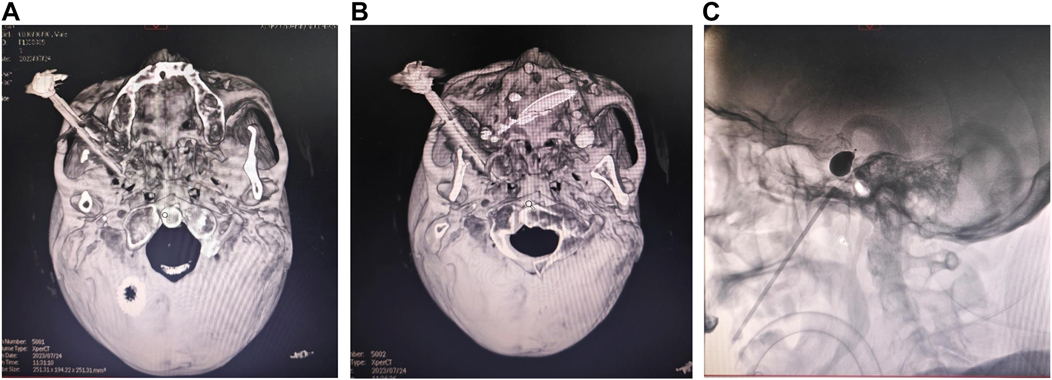 CT scan images in three panels labeled A, B, and C. Panel A shows a cross-section of a skull with a foreign object embedded. Panel B presents a different angle of the skull, highlighting the same object. Panel C displays a lateral view, focusing on the object's position relative to the head.