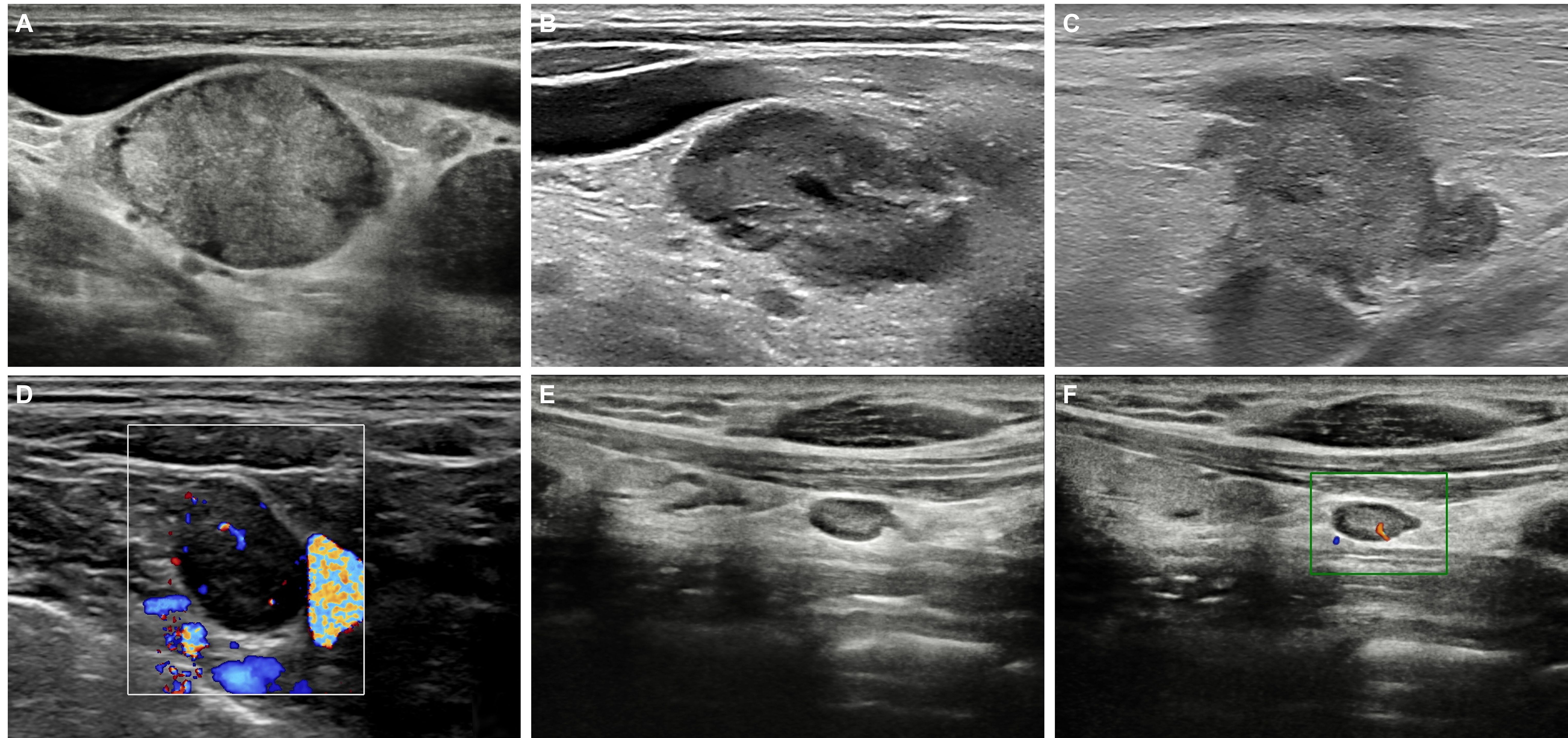 Ultrasound images show different views of a thyroid gland with nodule patterns. Panel A displays a large, well-defined nodule. Panel B illustrates a smaller, irregular nodule. Panel C presents a nodule with uncertain edges. Panel D features a Doppler ultrasound highlighting blood flow near the nodule. Panel E shows the gland with more texture detail. Panel F includes a colored Doppler box highlighting specific vascular structures.