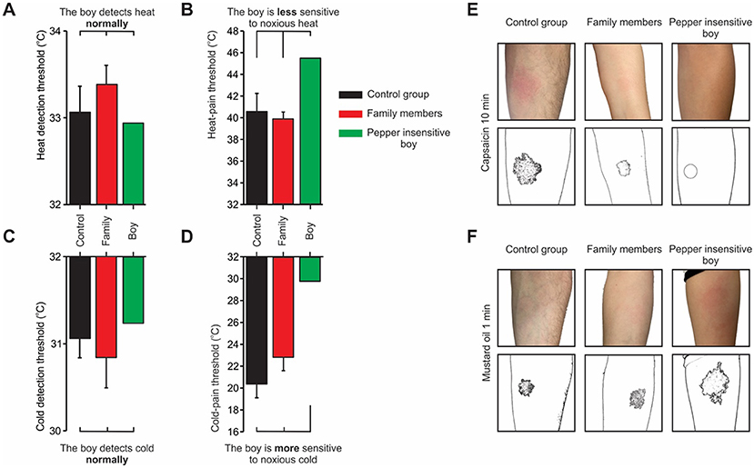 Graphs and images compare sensory thresholds between a control group, family members, and a boy insensitive to pepper. Graphs A and C show normal heat and cold detection for the boy. Graph B indicates the boy is less sensitive to noxious heat, while graph D shows increased sensitivity to noxious cold. Images E and F compare skin reactions to capsaicin and mustard oil, with differences in redness and affected areas outlined.