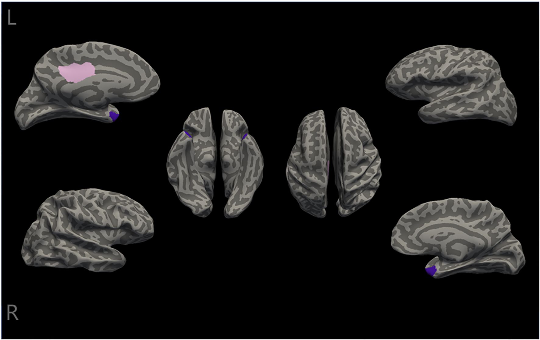 Graphic showing six views of a brain's surface, highlighting specific regions in pink and purple. Views include lateral, medial, and dorsal perspectives, with areas marked on both the left (L) and right (R) hemispheres.