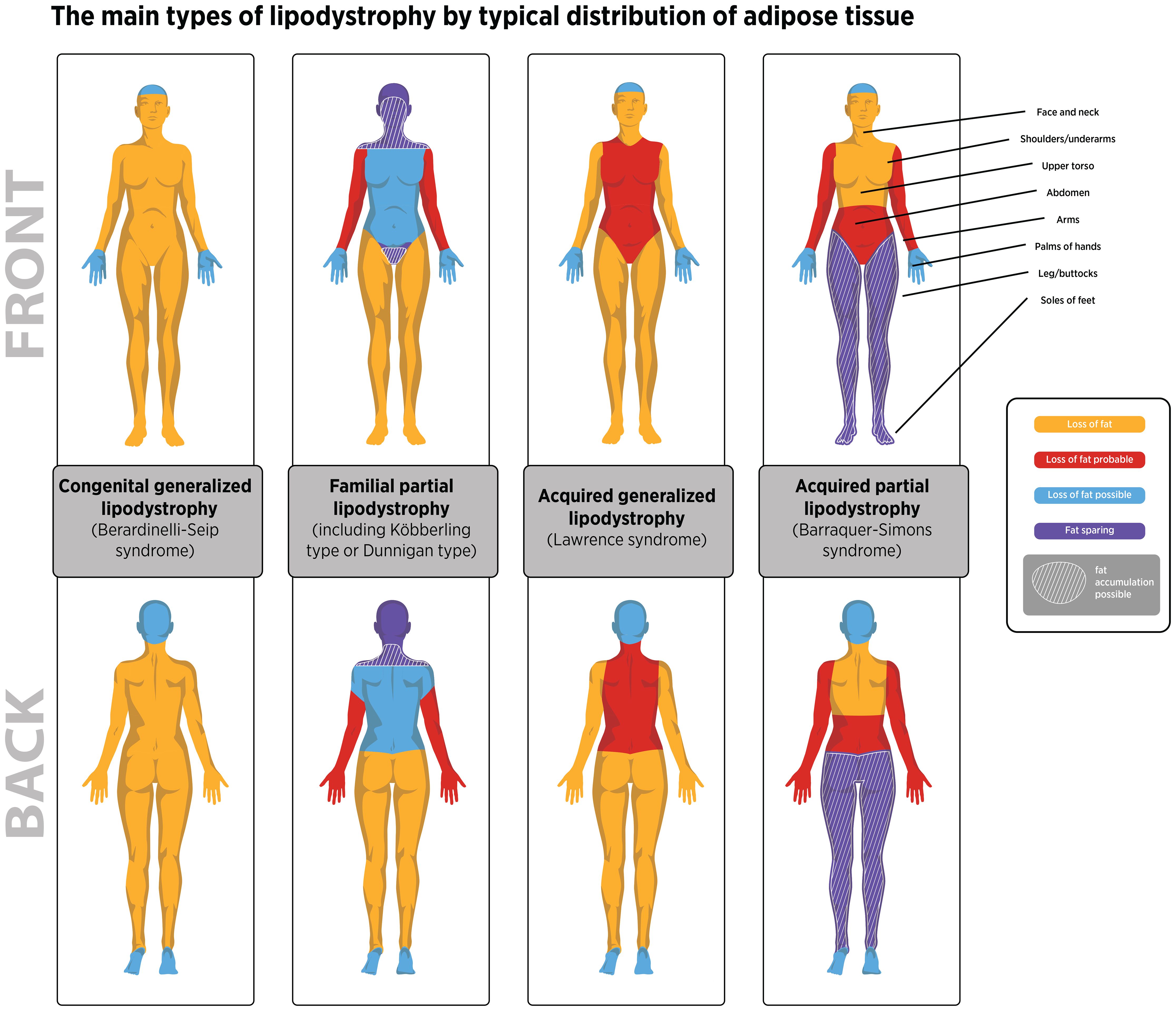 Diagram showing body maps of different types of lipodystrophy. Each panel highlights fat loss or sparing areas in male and female figures. Color-coded sections indicate loss of fat (red), probable loss (orange), possible loss (green), and sparing (blue). Each type listed includes a male-to-female ratio.