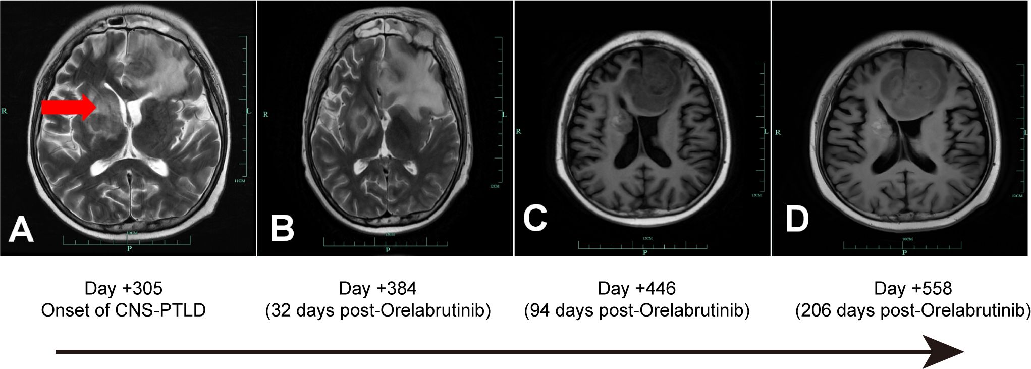 Four MRI brain scans labeled A to D show the progression of CNS-PTLD treatment over time. A red arrow in scan A highlights the onset of the condition. Scans B, C, and D, taken 32, 94, and 206 days post-Orelabrutinib treatment, respectively, illustrate progressive changes. Arrows indicate the timeline's direction.