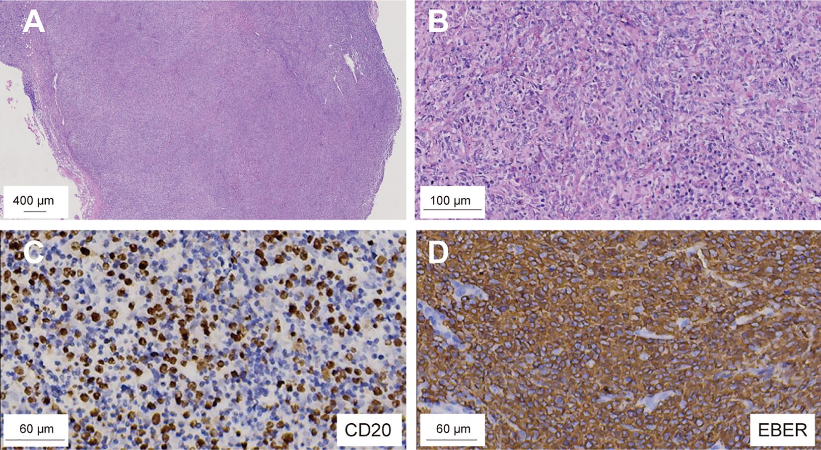 Composite image showing four histological slides with different magnifications. A: Low magnification view of tissue stained with hematoxylin and eosin, scale bar 400 micrometers. B: Higher magnification of similar tissue, scale bar 100 micrometers. C: Immunohistochemical staining for CD20, highlighting numerous darkly stained cells, scale bar 60 micrometers. D: In situ hybridization for EBER, showing extensive brown staining, scale bar 60 micrometers.