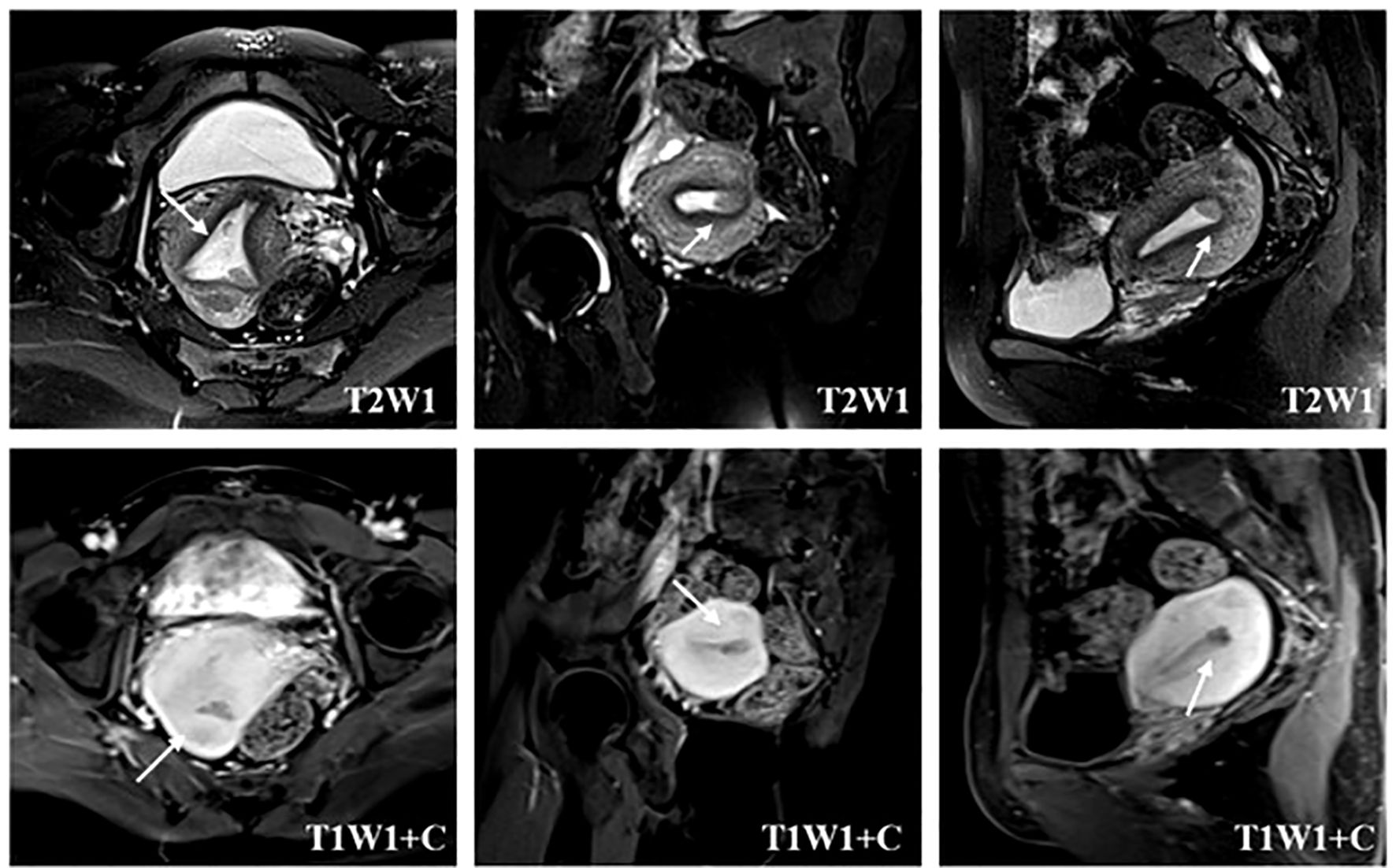 MRI scans in two rows, displaying axial, sagittal, and coronal views. The top row shows T2-weighted images (T2WI), highlighting internal structures with arrows indicating areas of interest. The bottom row shows T1-weighted images with contrast (T1WI+C), with arrows pointing to highlighted regions. Each image depicts detailed anatomical differences.