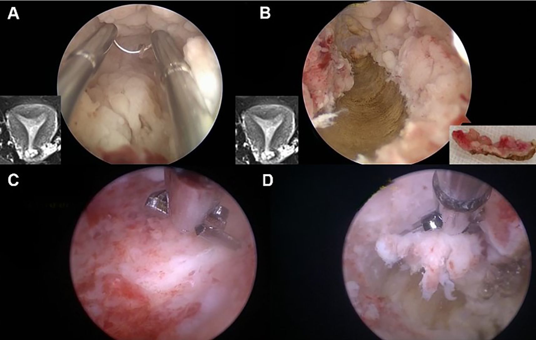 Medical images depicting different stages of a hysteroscopic morcellation procedure. Frame A shows an endoscopic view of the uterus with surgical tools. Frame B presents a removed tissue sample alongside a small inset image of the morcellated tissue. Frames C and D display detailed views of tissue being cut and removed. Each frame includes an accompanying MRI image for context.
