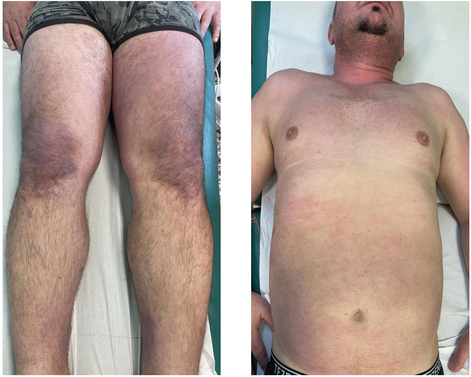A split image showing bruising on a person's thighs and a torso. The left side focuses on thighs with visible bruising and discoloration. The right side shows the person's chest and abdomen while lying on a medical table, with subtle skin redness.