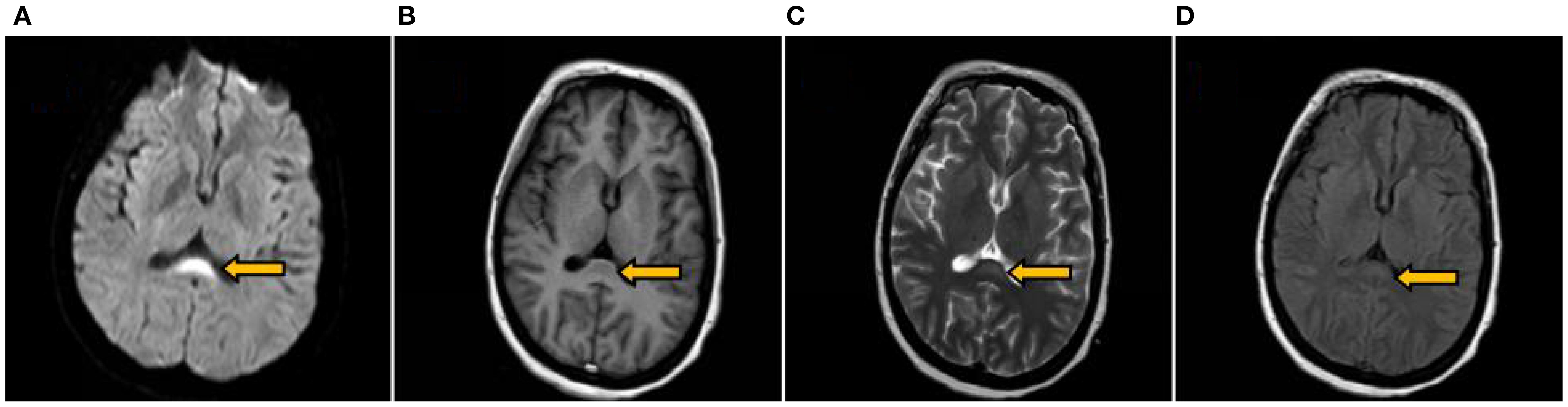 Four MRI brain scans labeled A through D, each showing different imaging techniques. Each scan features a yellow arrow pointing to a specific area within the brain, highlighting particular regions for study or diagnosis.