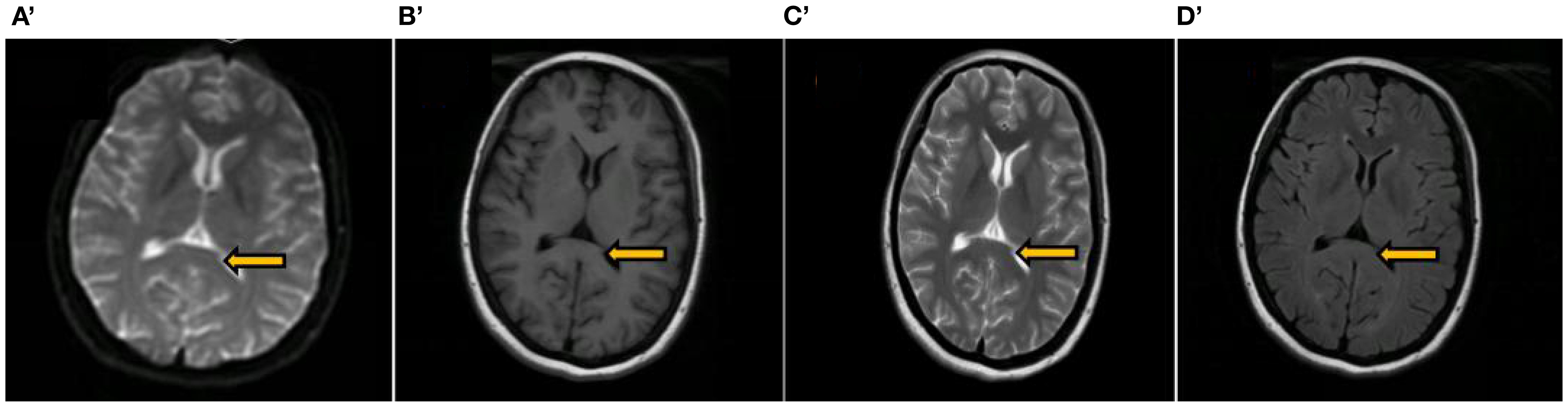 Four brain MRIs labeled A', B', C', and D'. Each image features a yellow arrow pointing to a specific area within the brain, highlighting different anatomical features or variations.