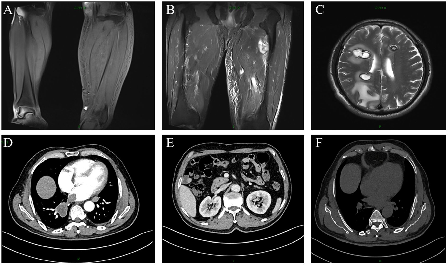 MRI and CT scan images showing various anatomical regions. Panel A presents two images of lower legs. Panel B displays an image of the upper thighs. Panel C shows a cross-section of a brain. Panel D features a chest cross-section. Panel E displays an abdominal cross-section with visible kidneys. Panel F shows another cross-section of the chest area.