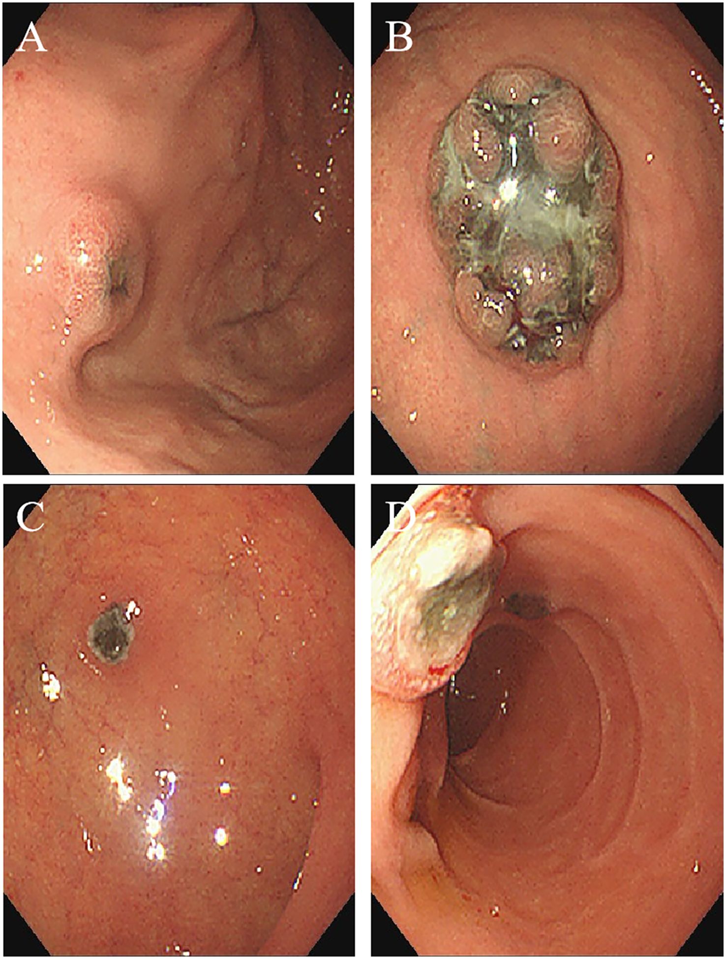 Four endoscopic images labeled A through D show various stages of gastric lesions. Image A displays a raised mucosal lesion. Image B shows a lesion covered with mucus and debris. Image C presents a flat lesion with a central depression. Image D depicts an ulcerated lesion in the lower gastrointestinal tract.