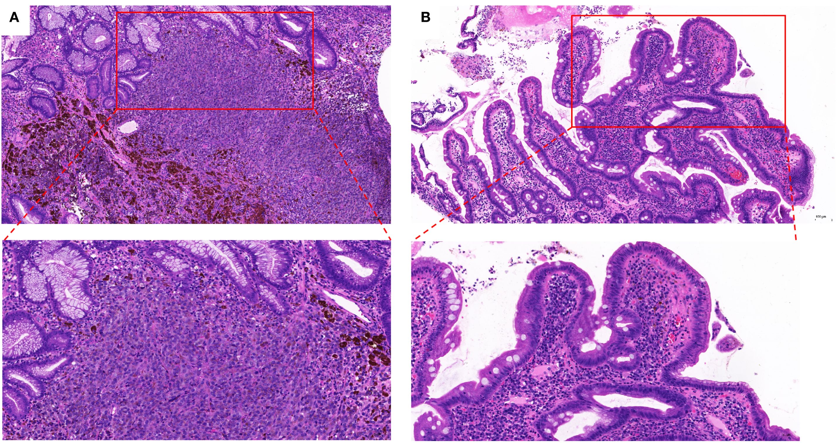 Microscopic images labeled A and B show tissue samples with a focus on different cell structures. A displays dense cell clusters with darker areas, while B highlights elongated, finger-like structures. Both images include insets with magnified views, marked by red boxes and arrows, to illustrate cellular detail.