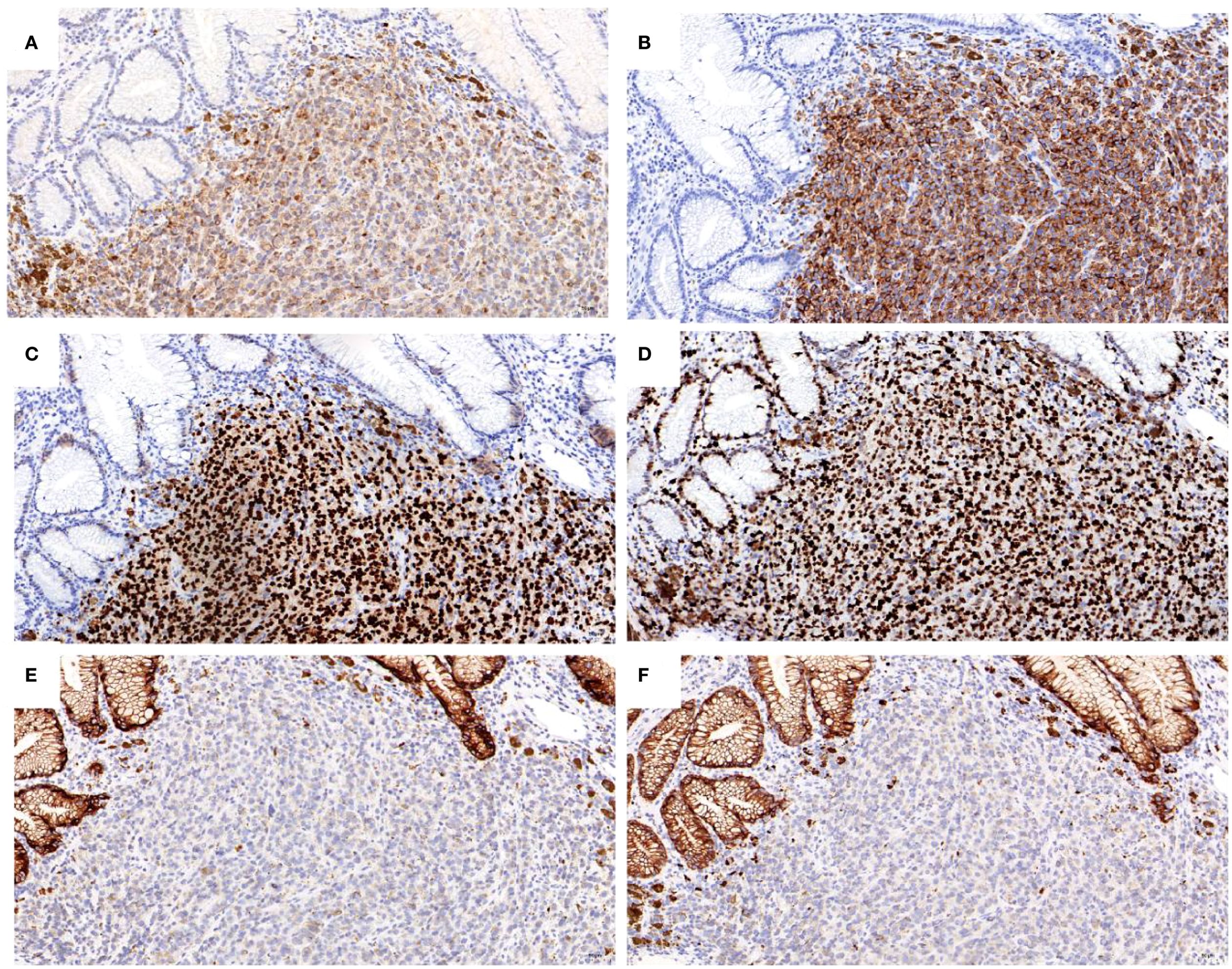 Microscopic images showing tissue samples with varying levels of staining intensity. Figures A and B display lighter staining, while C and D show a denser, darker pattern indicating higher staining. E and F depict moderate staining with noticeable differentiation in cell types. The samples illustrate differences in cellular structures and composition.