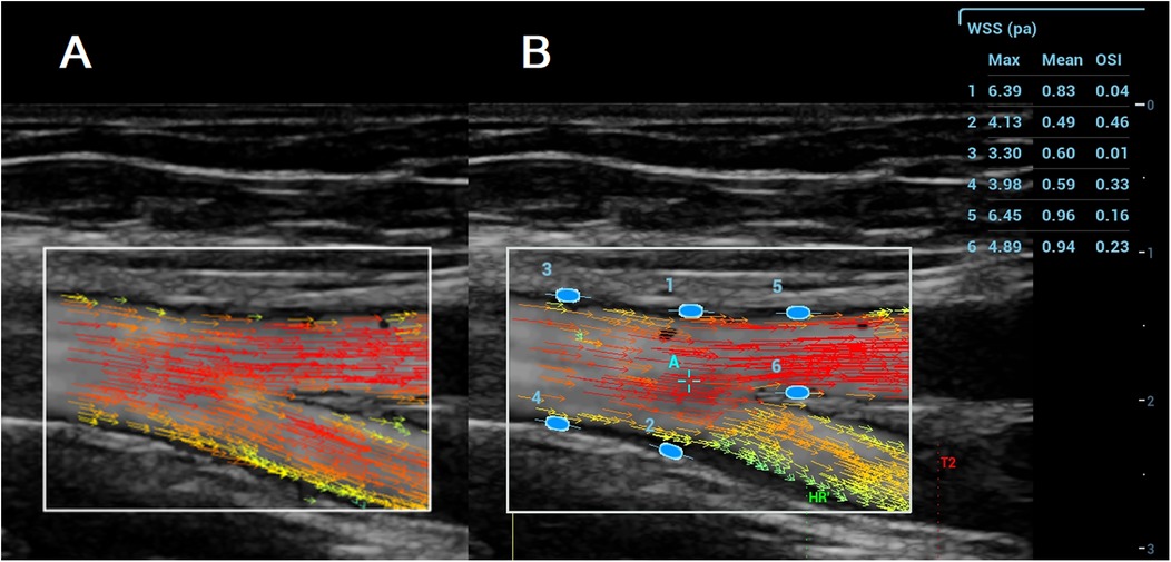 Vector Flow Ultrasound image showing blood flow in an artery, with colored arrows indicating velocity and direction. Panel A presents a side view with red, orange, and yellow arrows. Panel B displays a labeled view, featuring additional blue ellipses numbered one to six for Wall Shear Stress (WSS) measurement. A table on the right lists the WSS and Oscillatory Shear Index (OSI) values for each ellipse.