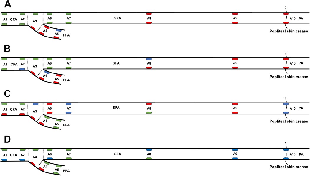Diagram of arterial segments labeled A1 to A10, showing the CFA, PFA, SFA, and PA. Subfigures A to D display Maximum Wall Shear Stress (WSS), mean WSS, Oscillatory Shear Index (OSI), and Relative Residence Time (RRT). For maximum WSS and mean WSS, green and red ellipses highlight values significantly higher and lower than the average. For OSI and RRT, green and red ellipses indicate values significantly lower and higher than the average.