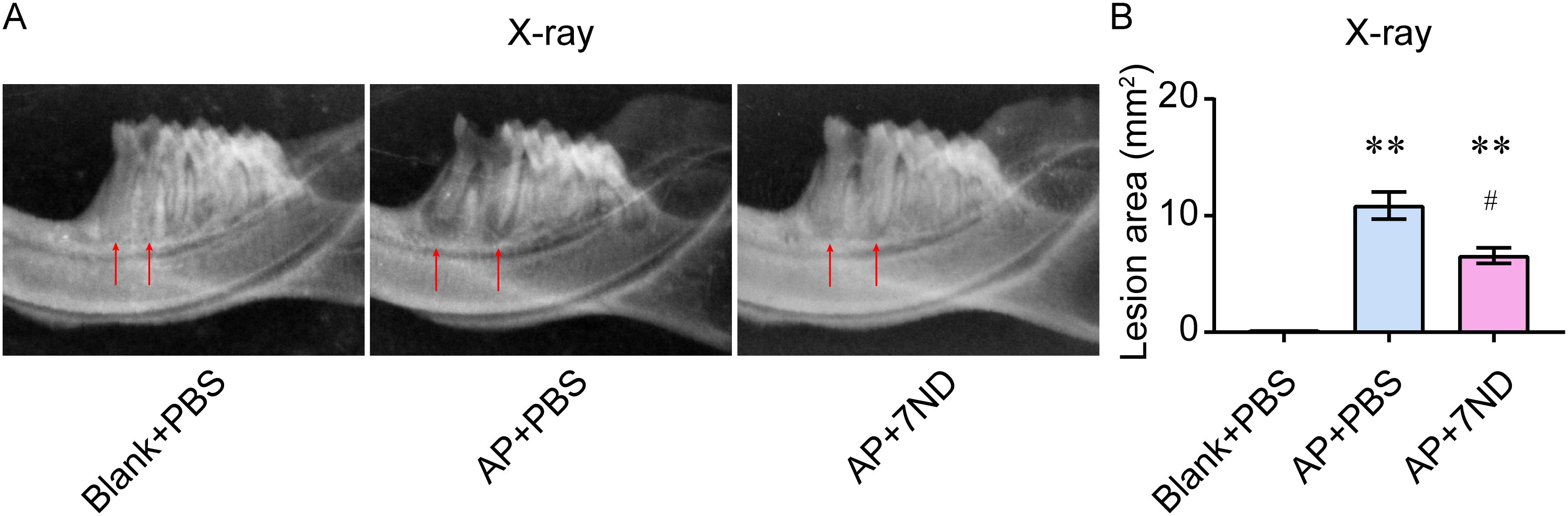 Three X-ray images and a bar graph depict lesion studies in different conditions: Blank+PBS, AP+PBS, and AP+7ND. Red arrows indicate lesion sites. The bar graph shows lesion area measurements in square millimeters, with AP+PBS having the largest, followed by AP+7ND. Statistical significance is indicated with symbols.