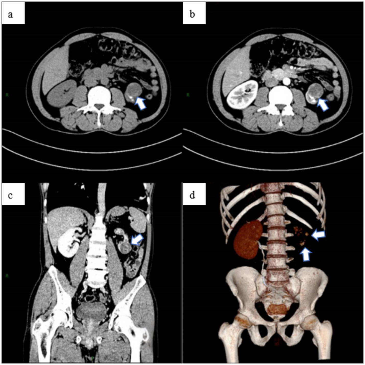 CT scan images displaying a case of intestinal obstruction. Panel (a) and (b) show axial views with arrows indicating the site of obstruction. Panel (c) provides a coronal view highlighting bowel distention. Panel (d) presents a three-dimensional reconstruction focusing on the affected intestinal region.