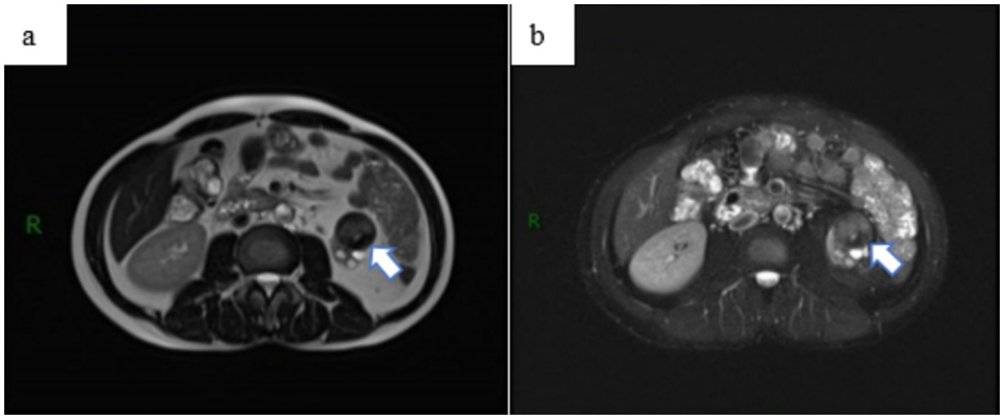 Two MRI scans labeled a and b show cross-sectional views of the abdomen, highlighting a lesion in the right kidney with arrows. The images vary in contrast, revealing different tissue densities.