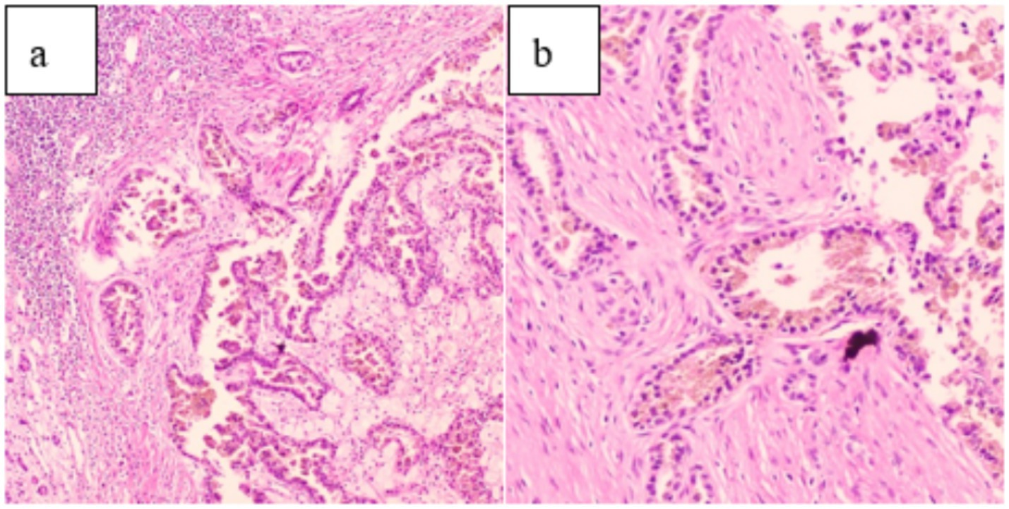 Histological comparison of two tissue sections labeled a and b. Image a shows a dense arrangement of cells with glandular structures. Image b depicts a more fibrous tissue pattern with fewer cellular components. Both images are stained to highlight cellular and structural details.