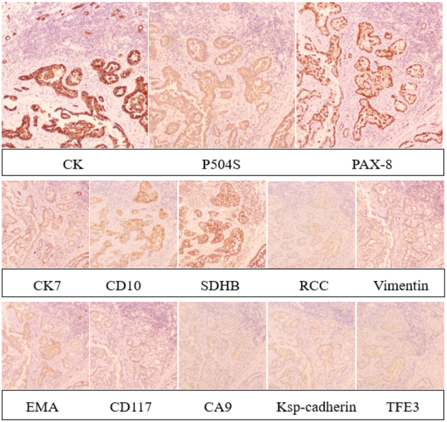 Microscopic slide images showing immunohistochemical staining patterns for various markers. The panels are labeled CK, P504S, PAX-8, CK7, CD10, SDHB, RCC, Vimentin, EMA, CD117, CA9, Ksp-cadherin, and TFE3. Each panel displays different staining intensities and patterns, illustrating the expression of these proteins.