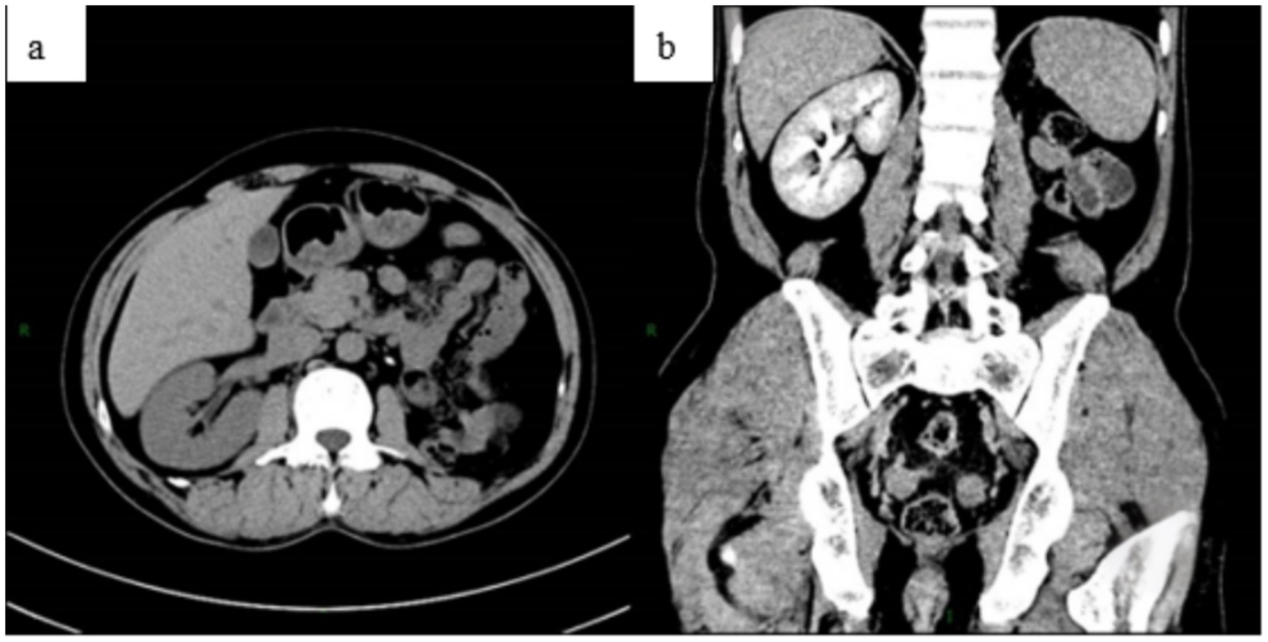 CT scan images showing abdominal views. Panel (a) displays a transverse cross-sectional view of the abdomen, with internal organs visible. Panel (b) presents a coronal section view of the abdomen, showing the arrangement of internal structures.