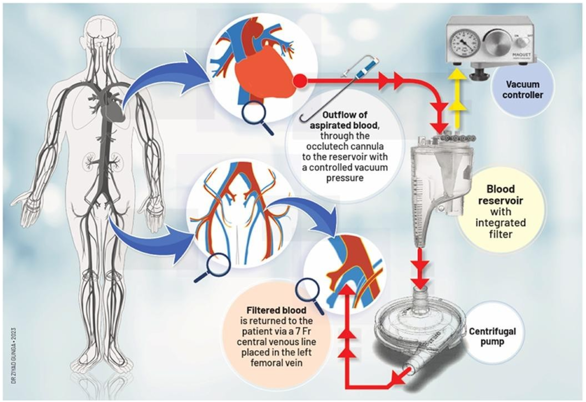 Diagram showing a medical blood filtration process. Blood is aspirated and directed to a reservoir via a vacuum controller. The reservoir contains an integrated filter. The filtered blood is pumped back into the patient's body using a centrifugal pump, specifically through a 7 French central venous line in the left femoral vein. Arrows and magnified insets illustrate the blood flow and anatomy involved.