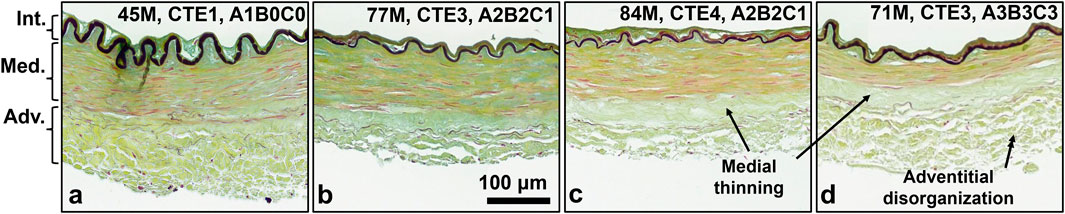 Histological comparison of arterial wall sections labeled a to d, showing the intima, media, and adventitia layers. Panels show varying degrees of medial thinning and adventitial disorganization across different conditions. Each panel is labeled with codes indicating specific experimental parameters. A scale bar denotes 100 micrometers.