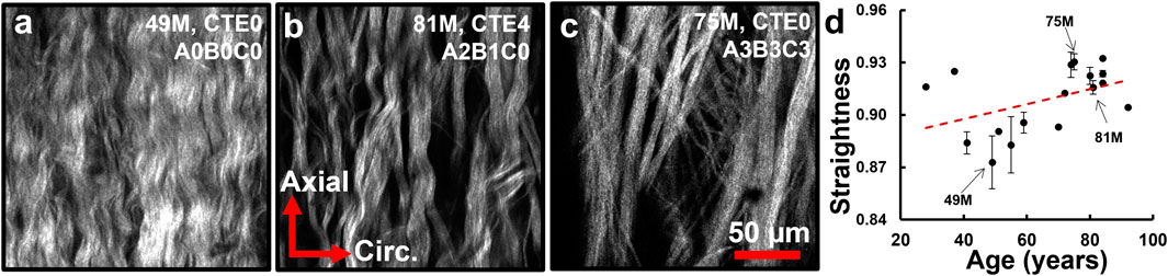 Panels a, b, and c depict microscopic images of tissue fibers from subjects aged forty-nine, eighty-one, and seventy-five years, respectively, with annotations like CTE0 and axial directions. Panel d shows a scatter plot of straightness versus age with a trend line, highlighting points for ages forty-nine, seventy-five, and eighty-one.