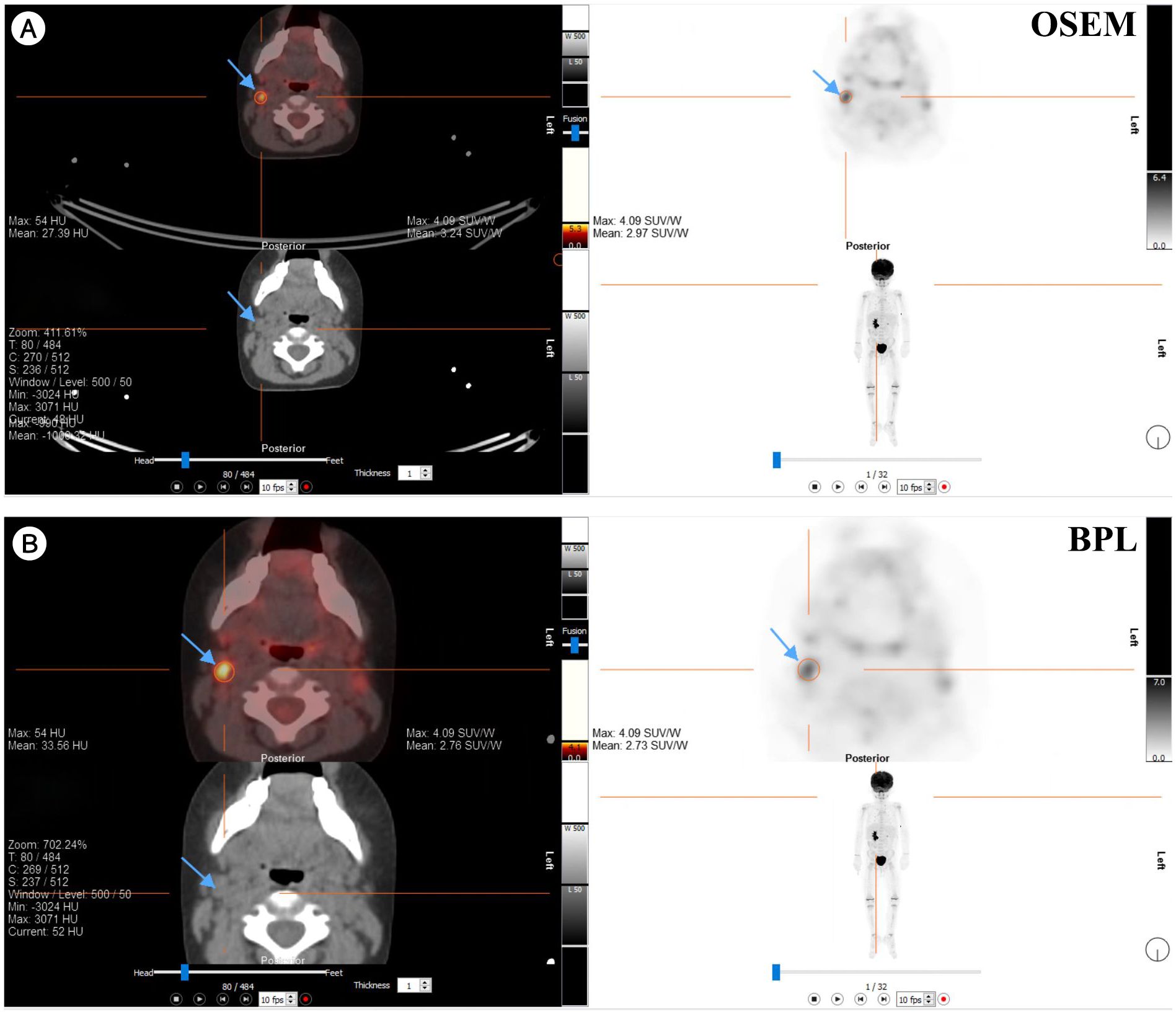 PET/CT fusion images comparing OSEM and BPL reconstruction methods using ¹⁸F-FDG in a patient with a right neck Level IIA lymph node mass. Panel A shows the OSEM reconstruction, with blue arrows indicating regions of FDG uptake and their corresponding SUV values. Panel B shows the BPL reconstruction of the same regions. Both panels include annotations and fused PET/CT details.