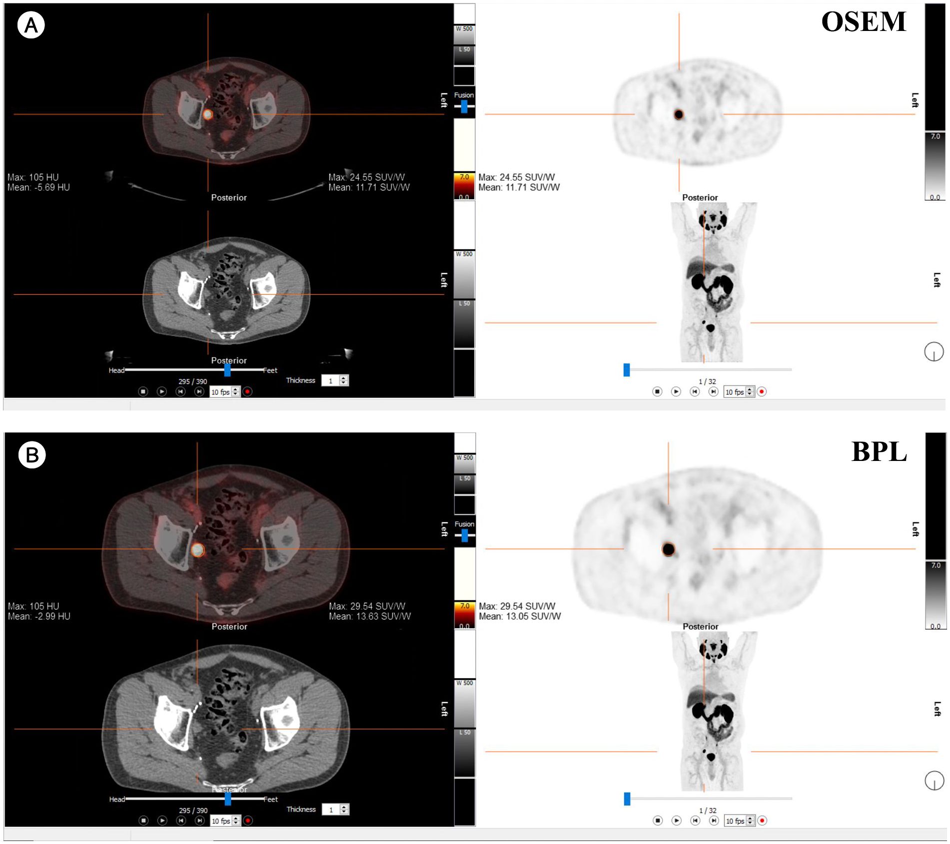 PET/CT fusion images comparing OSEM and BPL reconstruction methods using ⁶⁸Ga-PSMA-11 in a patient with a right external iliac mass. Panel A shows OSEM with blue arrows indicating regions of PSMA uptake and corresponding SUV values. Panel B shows BPL reconstruction of the same regions. Both panels contain annotations and fused PET/CT details.