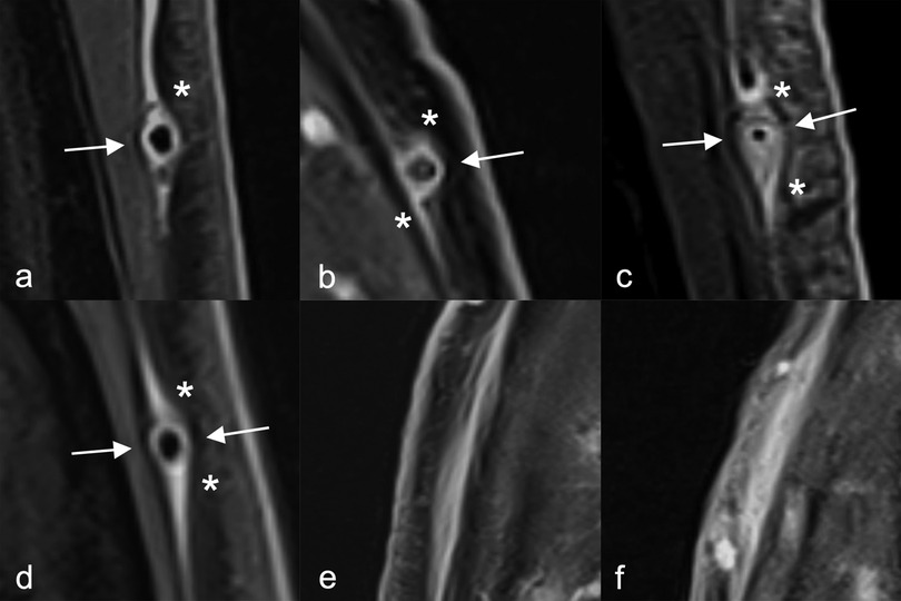 MRI images in black and white showing arteries in cross-section with asterisks marking areas of measurement of the vessel wall and arrows marking areas where not to measure.