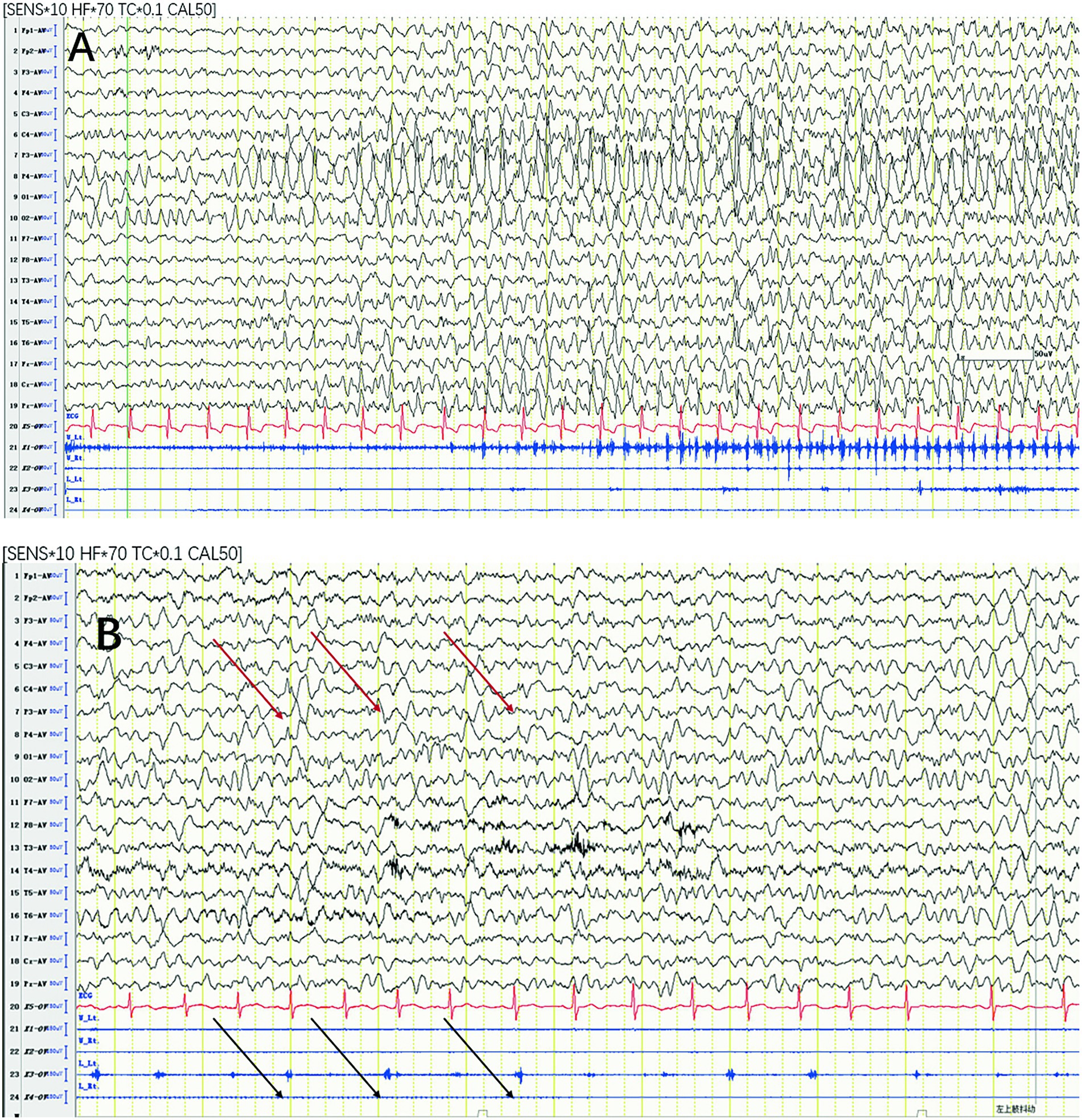 EEG recordings labeled A and B. Both display oscillating wave patterns. Graph A shows heightened activity, while Graph B includes annotated red and black arrows, indicating specific signal changes.