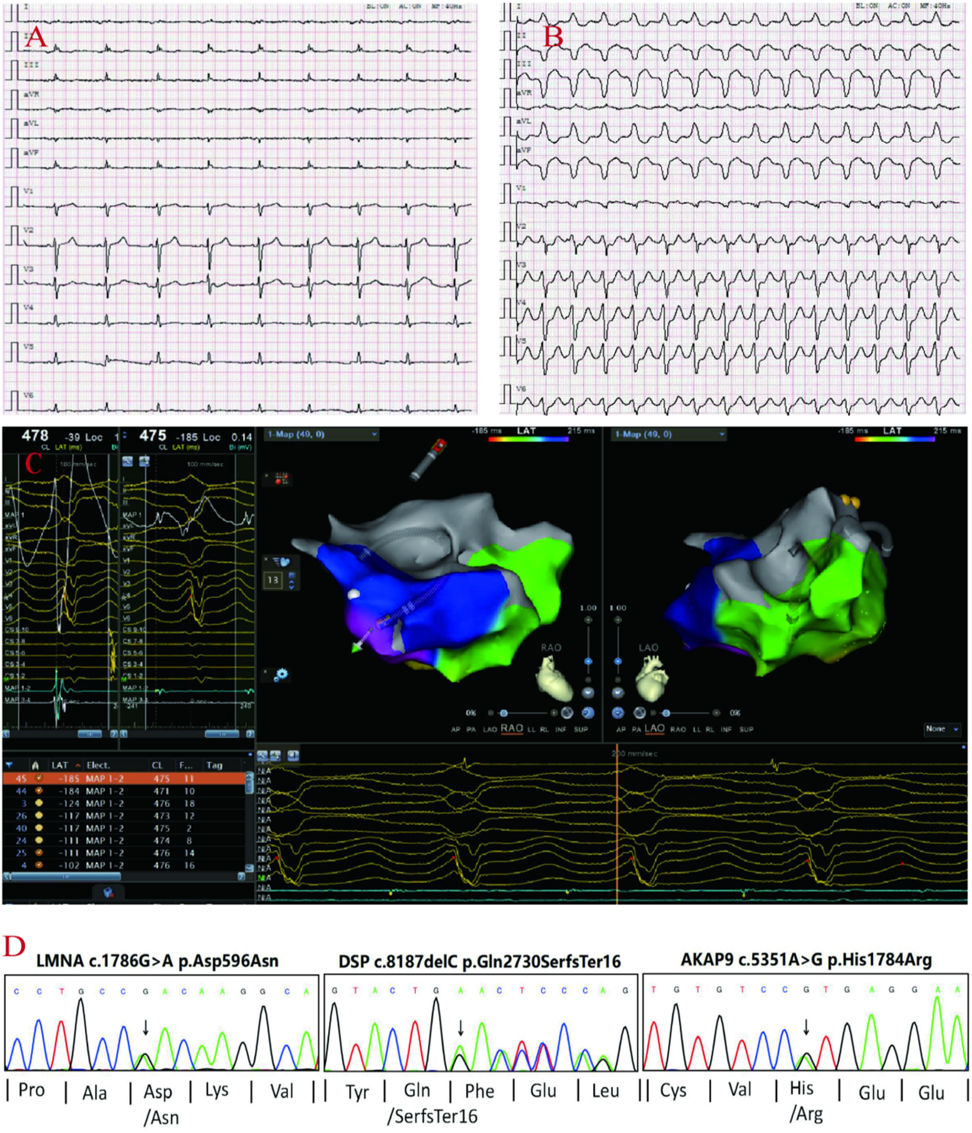 Panel A shows an electrocardiogram with multiple leads illustrating heart rhythm. Panel B displays a different ECG with irregular patterns. Panel C features electrophysiology recordings and a 3D heart map with color-coded regions. Panel D presents genetic sequencing graphs for LMNA, DSP, and AKAP9 genes with annotations for mutations affecting amino acids.