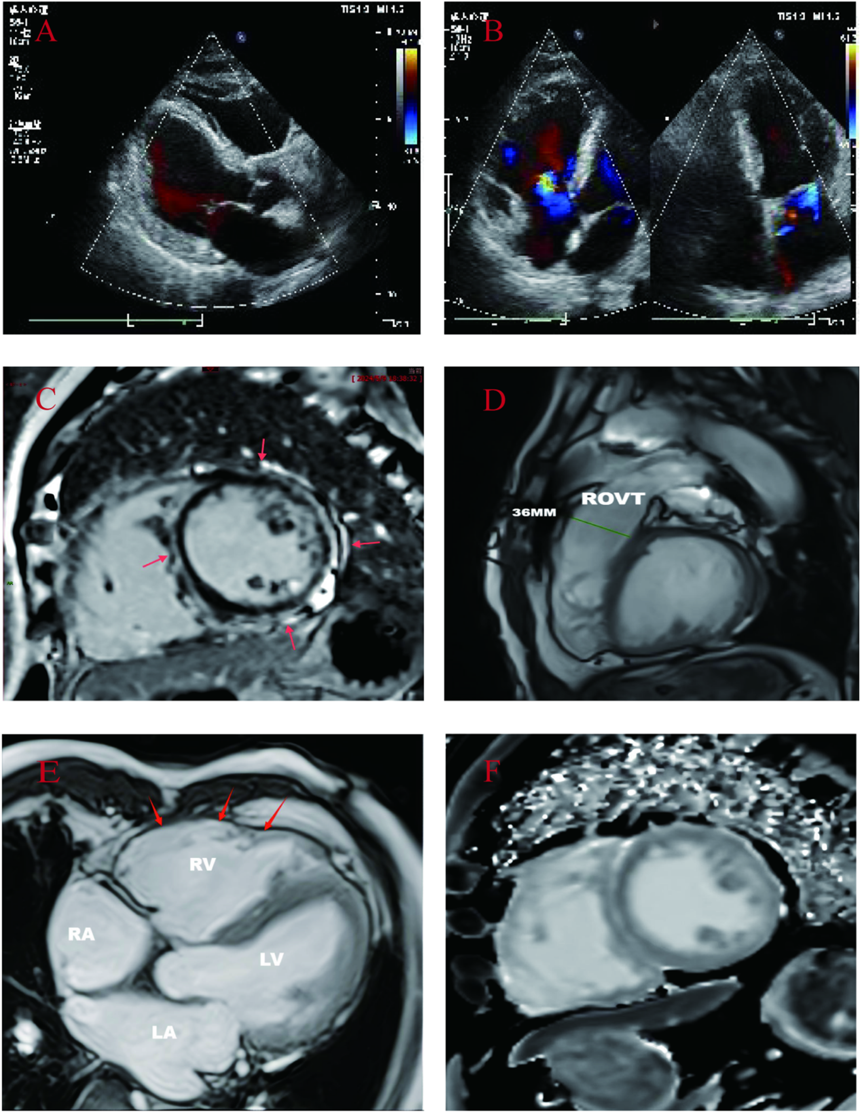 Medical imaging montage: Panel A shows a Doppler echocardiogram with red color flow. Panel B contains Doppler echocardiograms showing red and blue color flows. Panel C is a cardiac MRI with arrows pointing to specific areas. Panel D displays an MRI with a measurement labeled \"36MM\" and \"ROVT.\" Panel E is a cardiac MRI showing labeled chambers: RA (right atrium), RV (right ventricle), LA (left atrium), LV (left ventricle). Panel F displays another cardiac MRI with focus on the heart structure.