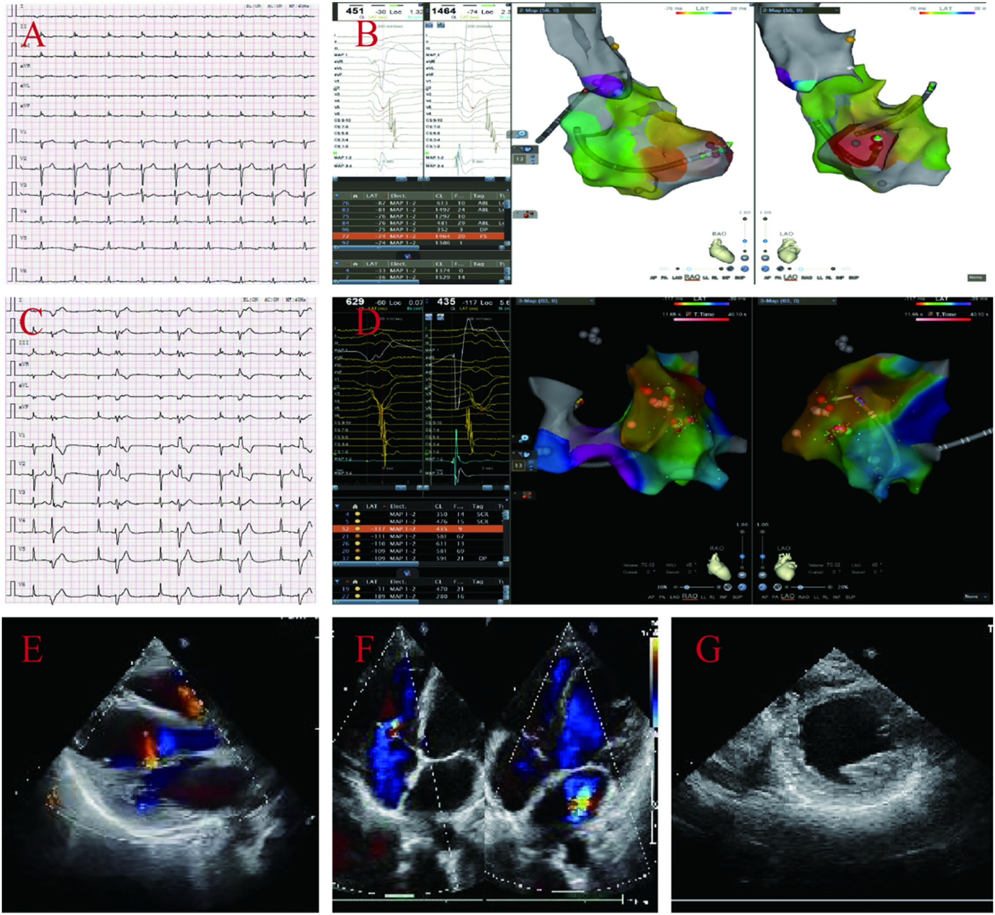 Panel A shows an electrocardiogram with multiple leads. Panel B displays cardiac electrophysiology data and 3D ventricular maps with colored regions indicating electrical activity. Panel C presents another electrocardiogram. Panel D shows additional electrophysiology data with 3D maps featuring activation points. Panels E and F are echocardiogram images highlighting blood flow in color Doppler mode. Panel G is a grayscale echocardiogram showing cardiac structure.