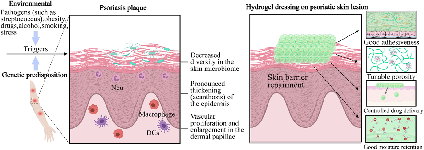 Illustration showing the development and treatment of psoriasis. Left panel: Environmental factors trigger psoriasis in genetically predisposed individuals, leading to plaques with noted epidermal changes. Middle panel: Psoriasis plaque characterized by decreased microbiome diversity, epidermal thickening, and vascular changes. Right panel: Effects of hydrogel dressing on psoriatic lesions, including skin barrier repair. Inset images highlight hydrogel properties: good adhesiveness, tunable porosity, controlled drug delivery, and moisture retention.
