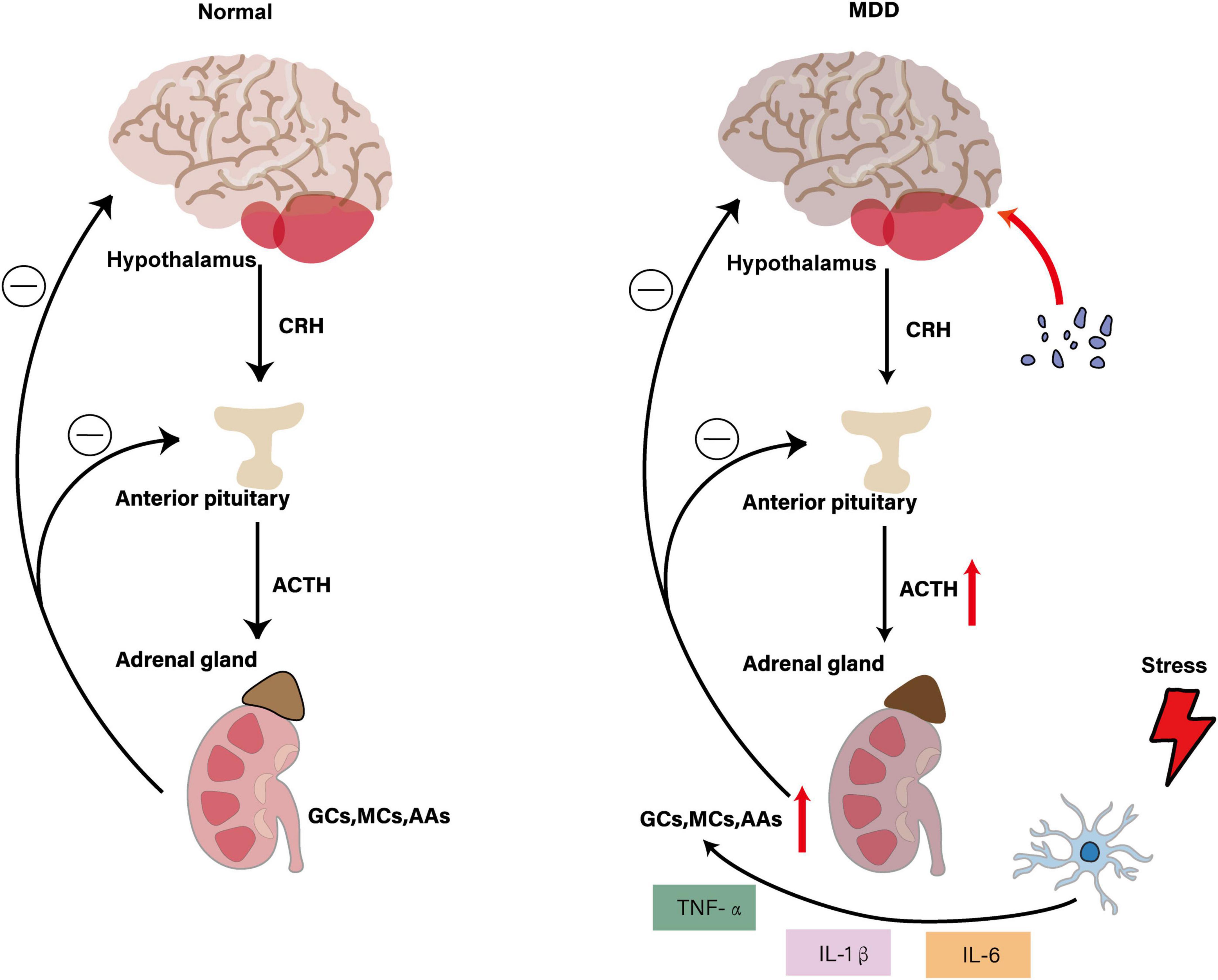 Diagram comparing the hypothalamic-pituitary-adrenal (HPA) axis in a normal state and in major depressive disorder (MDD). The left side shows a normal feedback loop with CRH from the hypothalamus, ACTH from the anterior pituitary, and steroids from the adrenal gland. The right side illustrates MDD with increased ACTH and adrenal output, showing stress impact and interactions with TNF-α, IL-1β, and IL-6. Arrows indicate feedback and hormone flow, with stress and cytokines marked.