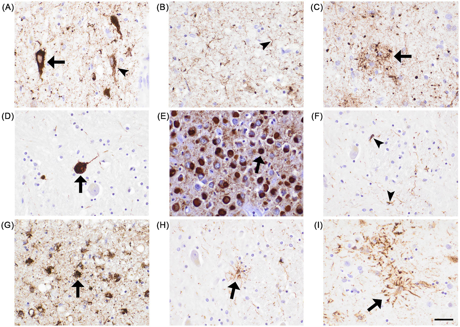 Histological images showing various types of tau pathologies in brain cells. Each image (A-I) highlights different tau pathologies with arrows and arrowheads indicating specific types. The background is light, making the stained pathologies appear prominently dark.