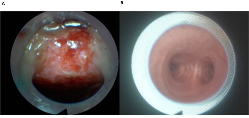 Image A shows an endoscopic view of a pinkish-red mass with a glossy surface, possibly indicating inflammation or another condition. Image B presents a clear, circular view of a tubular structure with a smooth, pink lining, potentially representing a normal anatomical feature.