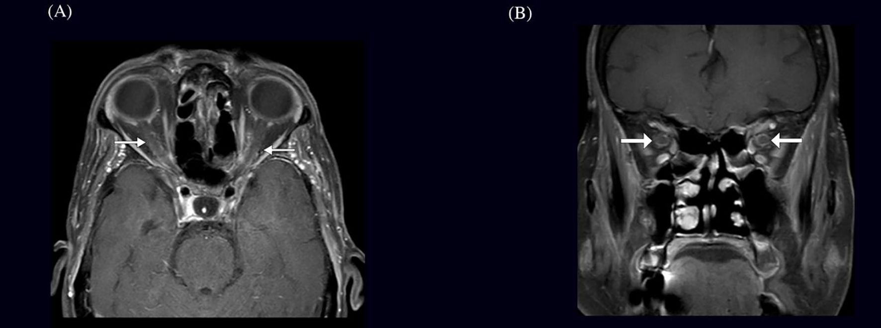 MRI scans showing two views of the head. Image A is an axial cross-section highlighting the optic nerves with arrows. Image B is a coronal view also highlighting the optic nerves with arrows.
