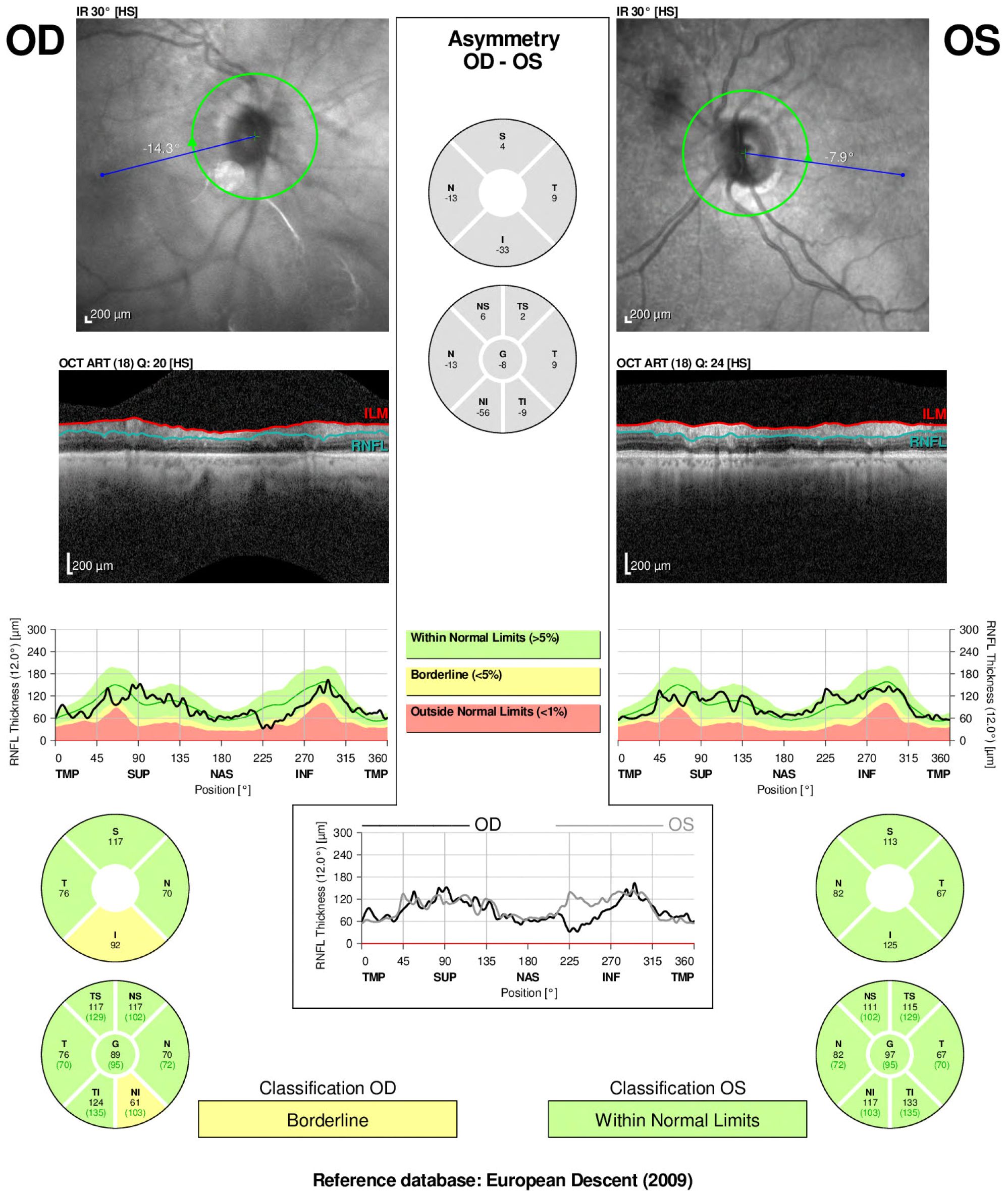 Optical coherence tomography (OCT) image analysis comparing the right eye (OD) and left eye (OS). Includes infrared retinal images, RNFL thickness graphs, and a classification diagram. The OD classification is borderline, while OS is within normal limits, based on a European descent reference database. Central asymmetry charts are shown, highlighting differences.