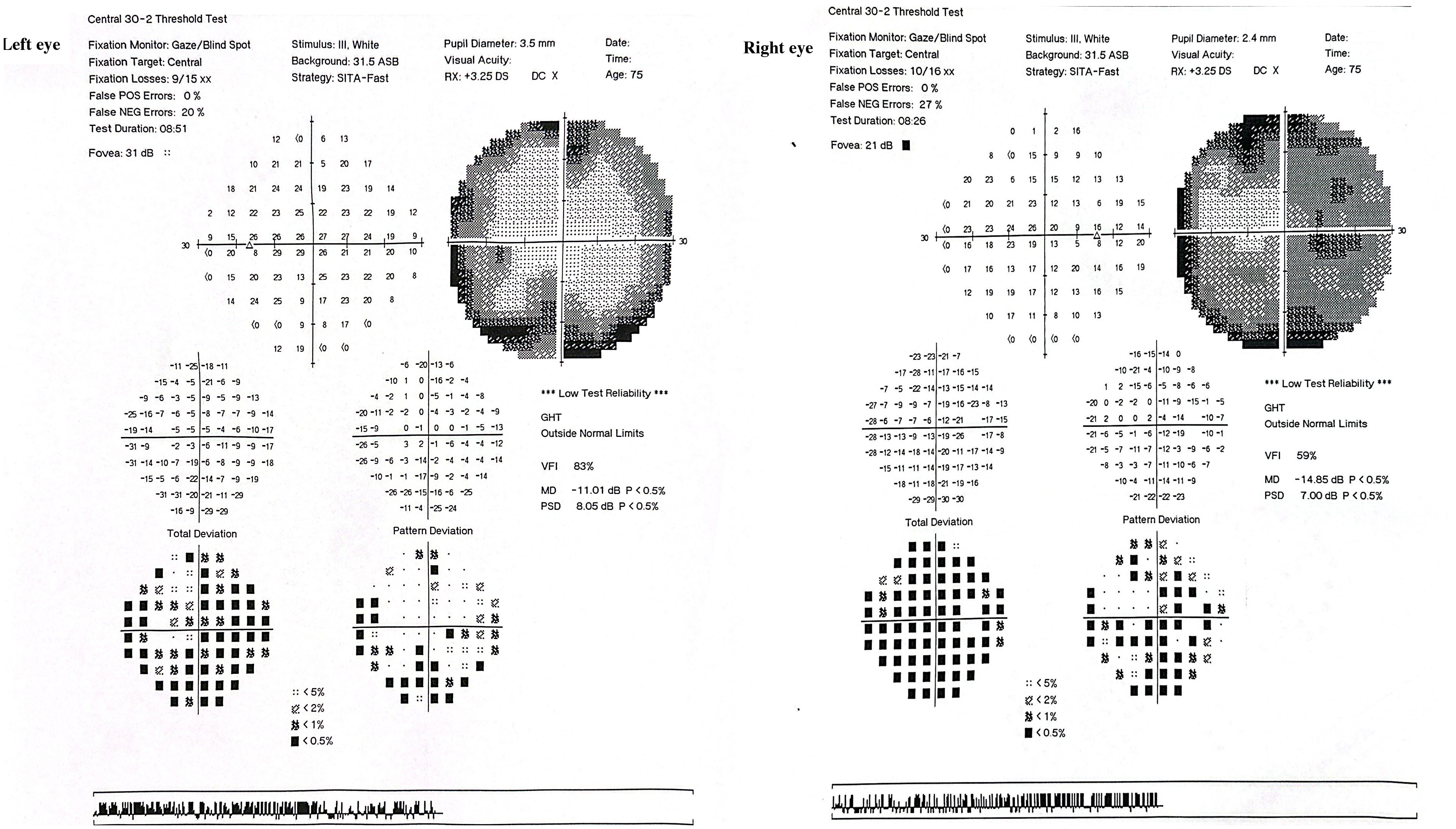 Two visual field test results labeled for the right and left eyes. Each side displays grayscale plots with data including fixation errors, test duration, fovea values, and deviations. Reliability is marked low with Global Indices showing various values and probabilities. Age is noted as seventy-five, with specific test parameters and statistical symbols beneath plots.