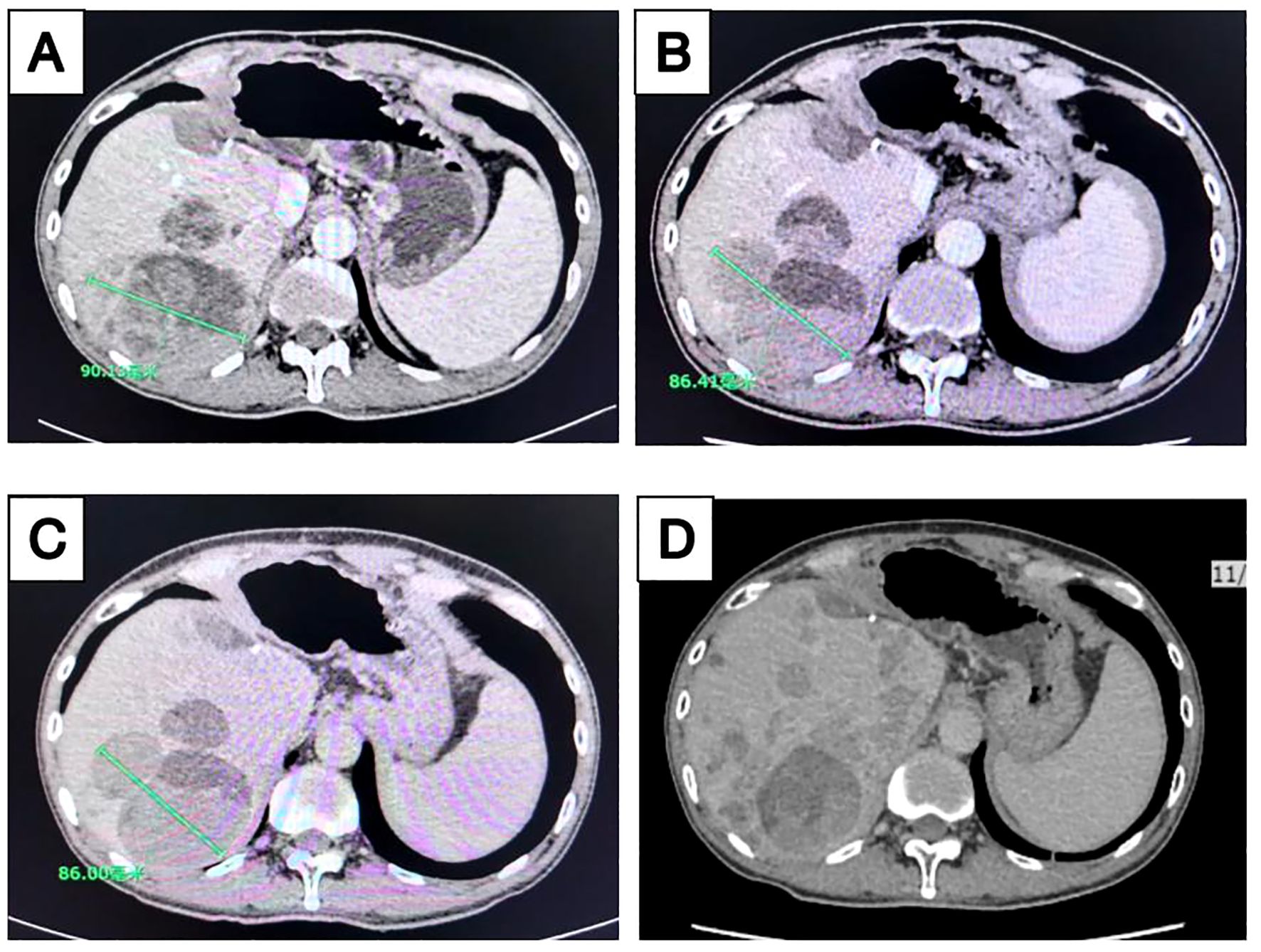 Four CT scan images labeled A, B, C, and D show cross-sectional views of the abdomen. Each image highlights internal organs and structures with varying degrees of contrast. Labels and measurements in green text are present, indicating specific dimensions in the first three images. Image A shows a measurement of 90.10, B of 86.41, and C of 86.00. Image D does not contain any measurements.